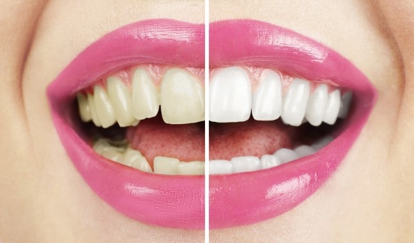 What Makes Ultima White Teeth Whitening Different Bicester