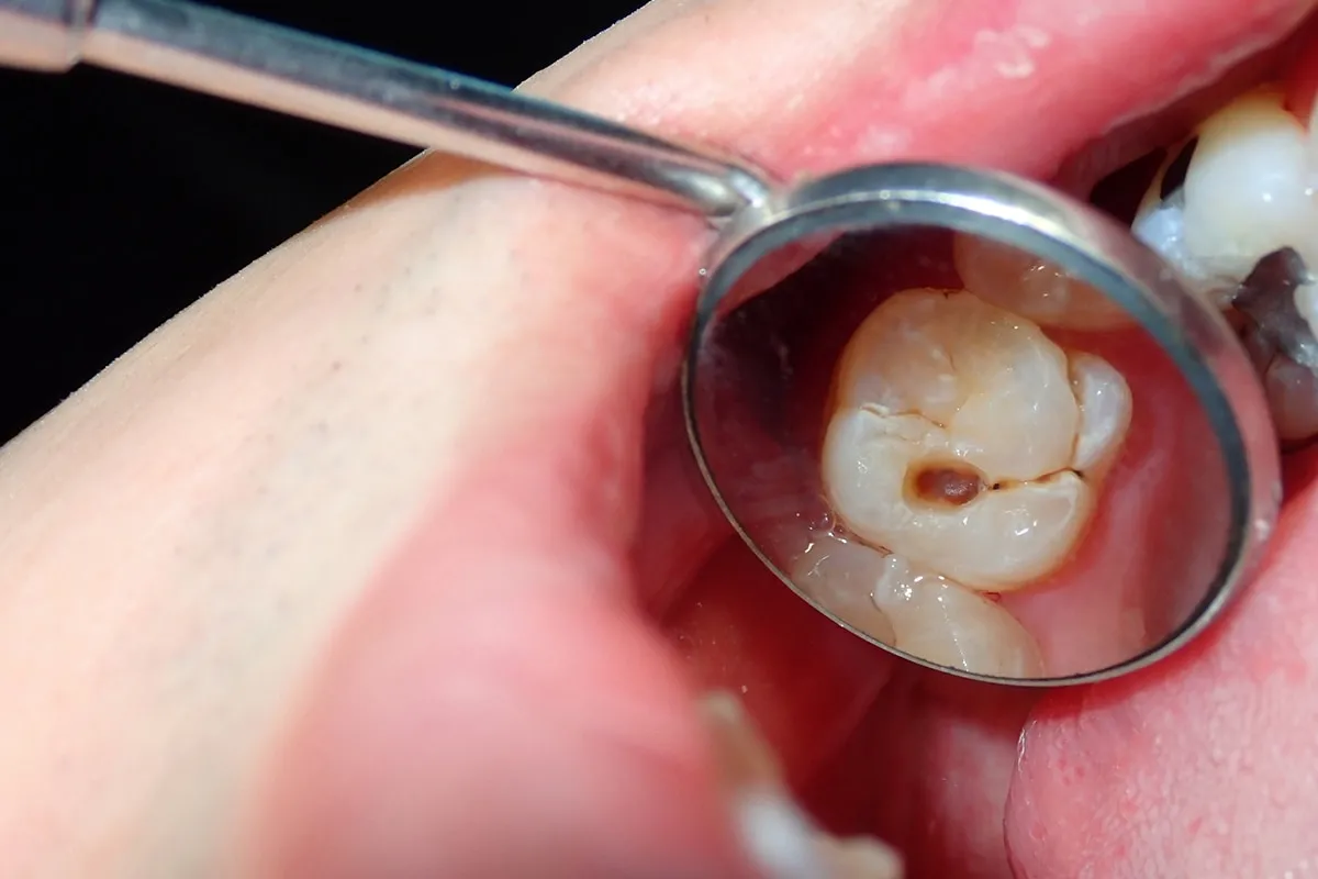 Why Do Teeth Crack? Common Causes to Know Bicester