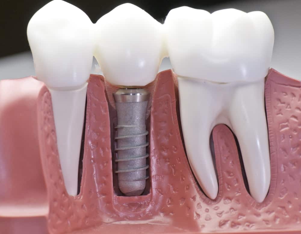 Who Is a Good Candidate for Dental Implants Bicester?