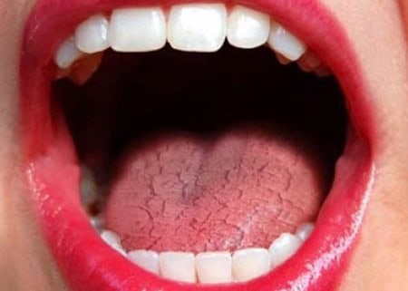 Common Causes of Dry Mouth (Xerostomia) Bicester