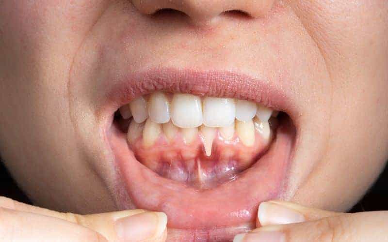 How Can Gum Disease Be Prevented Bicester?