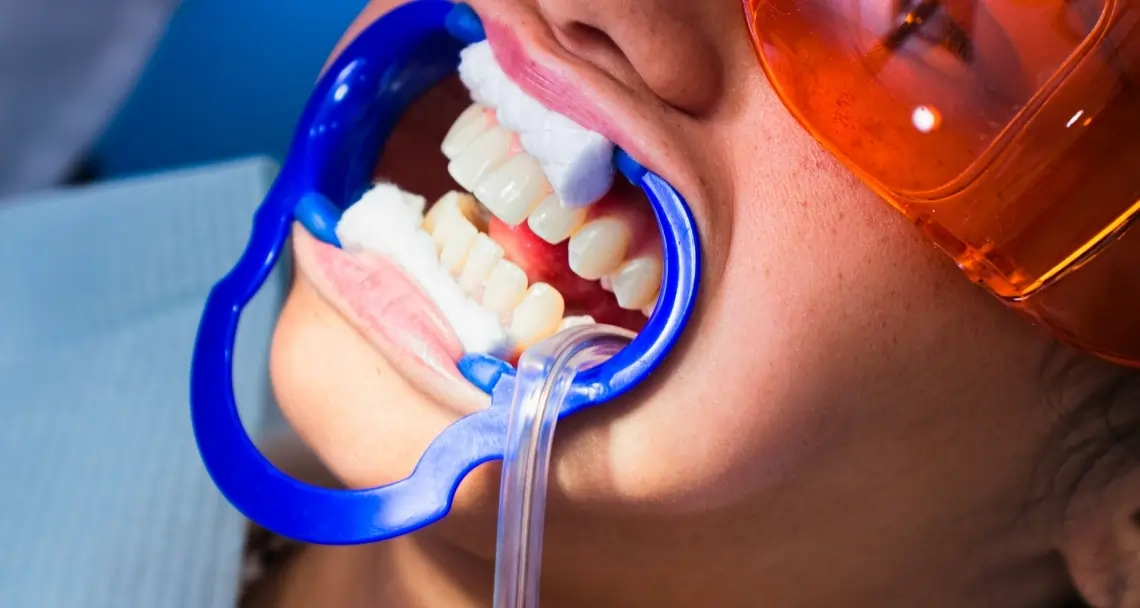 Post-Treatment Care {name} for Laser Teeth Whitening