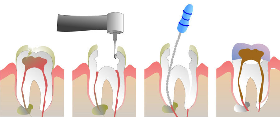 How Do You Properly Care for Your Teeth After a Root Canal Bicester