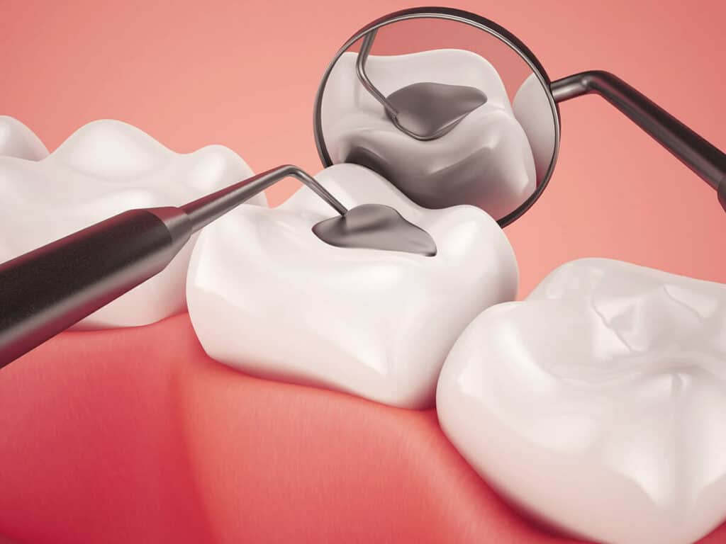 Fighting Cavities and Plaque Buildup Bicester