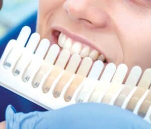 Ultimate Guide to Teeth Whitening with Natural Ingredients Bicester