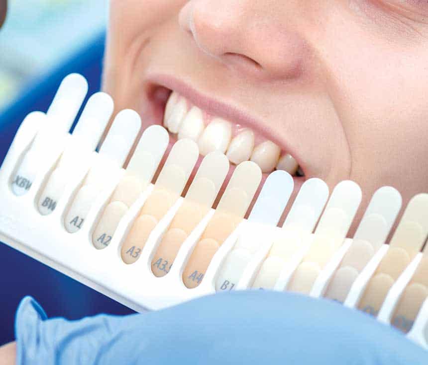 Professional vs At-Home Whitening: What You Need to Know Bicester