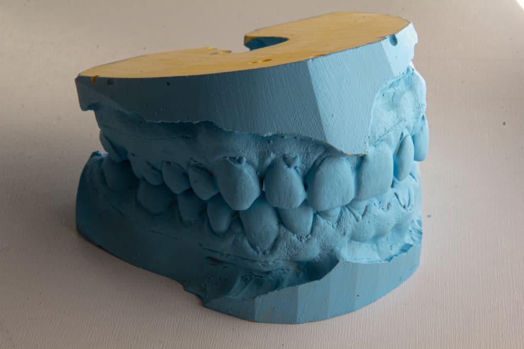 How Do Dental Implants Improve Jawbone Health and Oral Function Bicester?