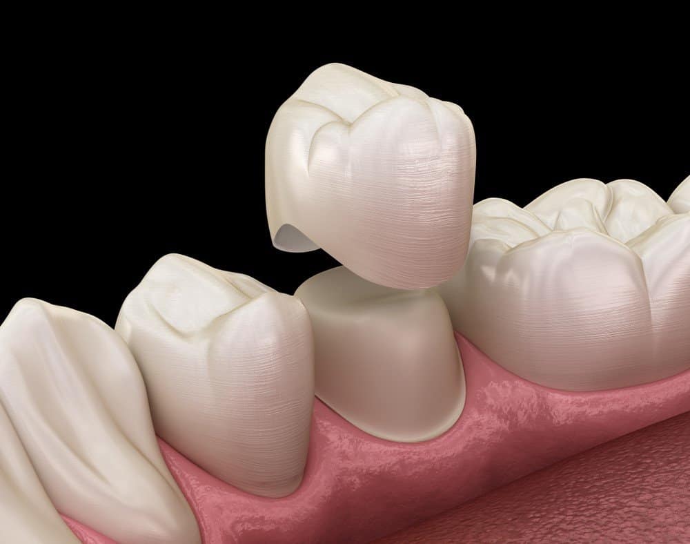 What Daily Habits Help Protect Your Dental Crowns Bicester?